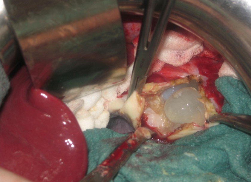  Intraoperative view showing multivesicular spleen hydatid cyst.