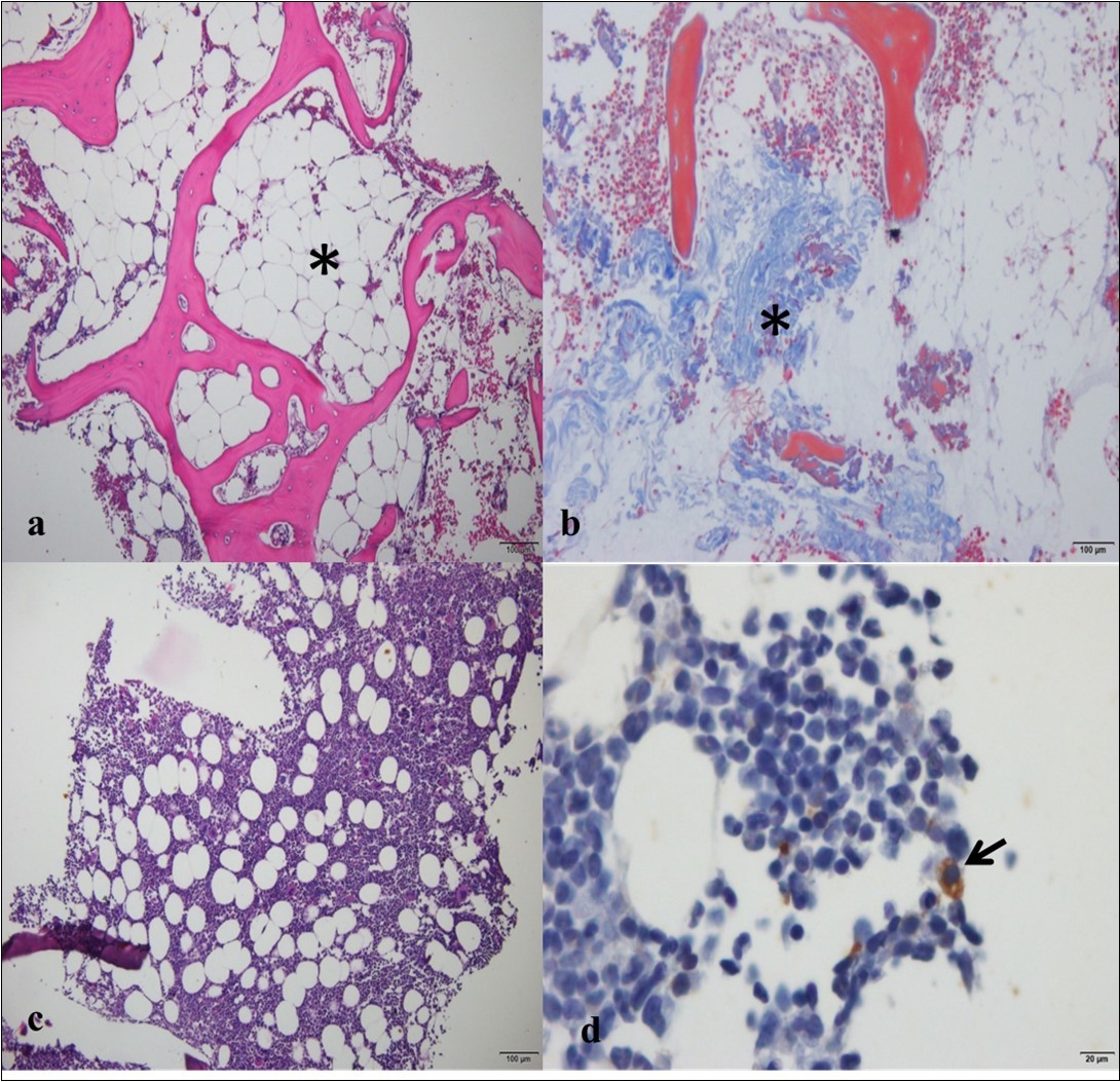  Photomicrographs of the bone marrow of a female dog with a mammary tumor. a) Note severe hypocellularity and predominance of adipose tissue (*), in a female dog positive for Ehrlichia canis                   (bar = 100 µm; hematoxylin and eosin). b) Note the proliferation of fibrous tissue (*) in the bone marrow (bar = 100 µm; Masson’s trichrome). c) Note the normocellular bone marrow in the analysis on the biopsy (bar = 100 µm; hematoxylin and eosin). d) Same animal as in C, showing an epithelial cell positive for                   cytokeratin-19 (arrow; bar = 20 µm; peroxidase-linked polymer complex).