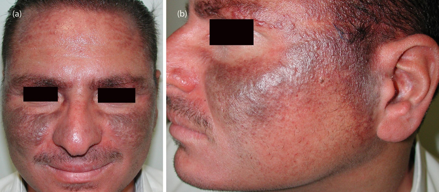 Isotretinoin (treatment for severe acne) induced Hyperpigmentation