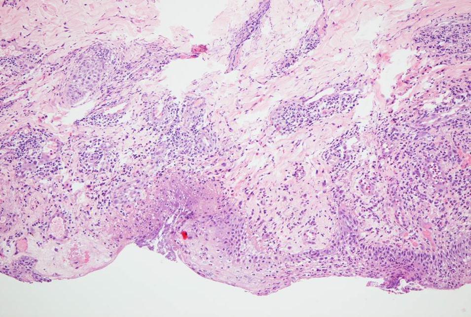  Histopathology of a laser and imiquimod treated basal cell carcinoma at the end of the study (day 20).Focal epidermal necrosis with moderate granulocytic demarcation and reactive perivascular lymphocytic and eosinophilic infiltrates. No residual neoplastic proliferates (HE, x200).