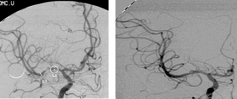  Right MCA before and after angioplasty and stenting