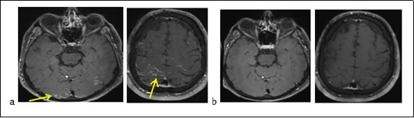  Brain MRI displaying occipital cortical hypersignals in Flair sequences (a) and decrease of lesions (b)