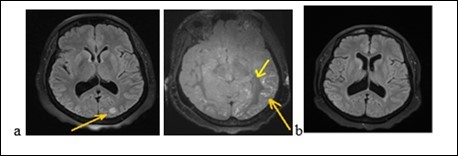 Cerebral MRI showing a left occipital edema and a diffuse contrast enhancement of the leptomeninges (a) with complete decrease of the              lesions after treatment (b)