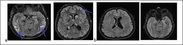  The brain MRI with flair sequences showing bi-temporal and frontal hyper signals (a) and a complete decrease of lesions after treatment (b).