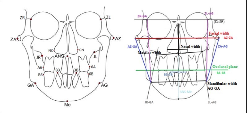  Reference points and planes in the Ricketts analysis used to measure cephalometric parameters in      facial asymmetry patients