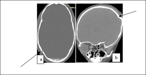  Image of a brain CT scan without contrast agent injection in a bone  window, axial section showing a right parieto-occipital fracture (a), coronal     section showing a left parietal skull depressed fracture (b)