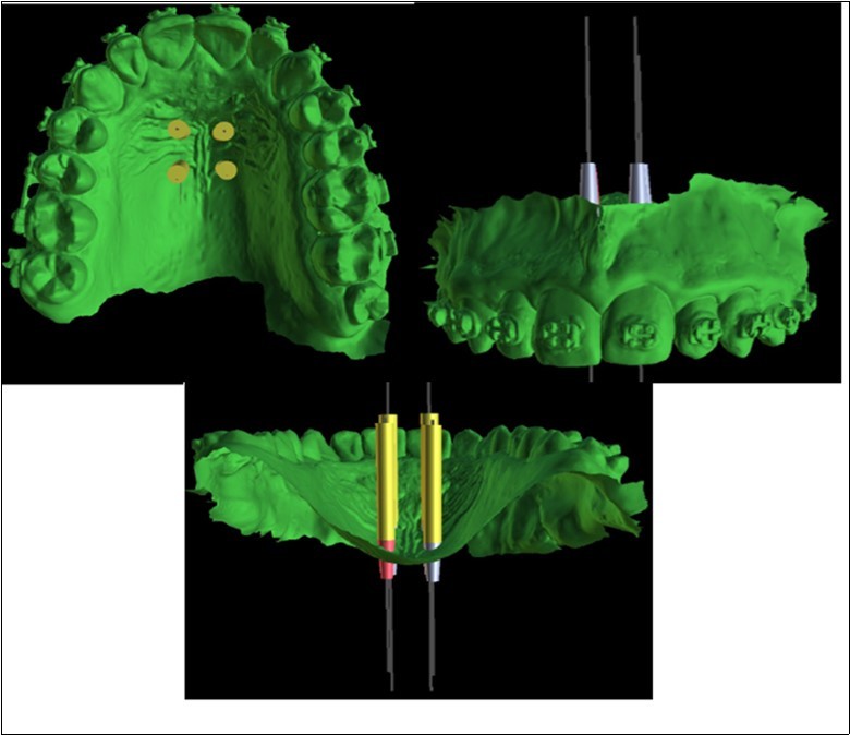  Positioning of the 4 mini-implants, visualized on the basis of the intraoral scan