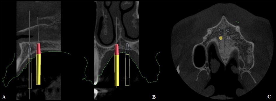  Positioning of the mini-implants on CBCT, A. Sagittal section, B. Coronal section, C. Axial section