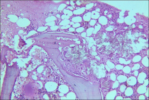  Photomicrograph of bone marrow core from case 1 showing radially arranged calcium oxalate crystals replacing haemopoietic tissue with invasion and destruction of bony trabeculae.  Areas of necrosis and a cluster of hemosiderin laden macrophages is visible.