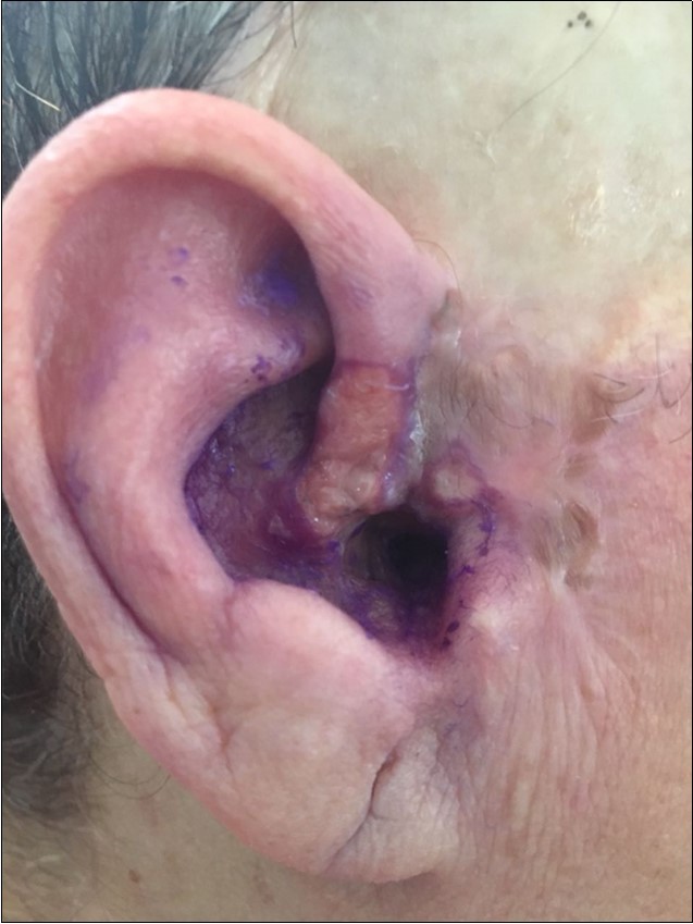  Right ear; Basal Cell Carcinoma (BCC) seen in the skin of ear and adjacent areas, removal of cancer cells after Bee Venom subcutaneous injection.