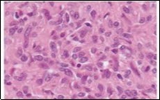  Angiomatoid fibrous histiocytoma exhibiting spindle-shaped tumour cells with abundant eosinophilic cytoplasm, bland nuclei and a vascular tumour matrix 14.