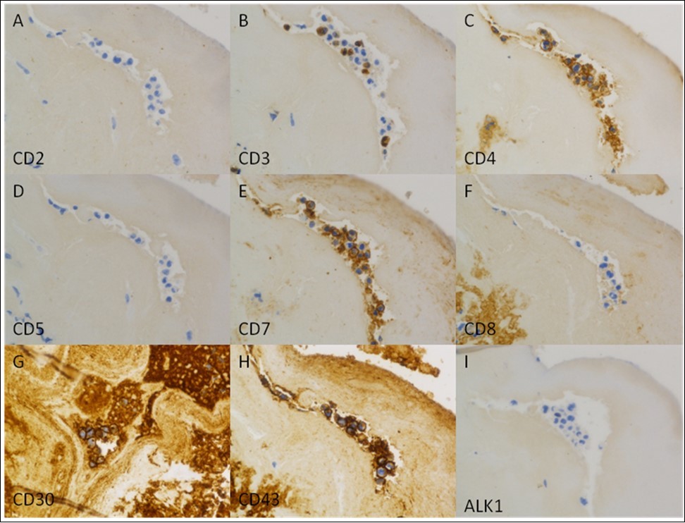 Immunohistochemical characterization of the tumor. The tumor cells are positive for CD3 (subset, B), CD4 (C), CD7 (E), CD30 (strong and uniform, G), and CD43 (H), and negative for CD2 (A), CD5 (D), CD8 (F), and ALK1 (I). (Immunoperoxidase staining; original magnification, x 400).