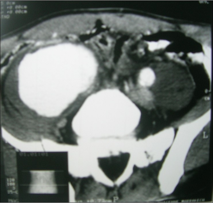  Angio CT scan revealed an aneurysm of the right common iliac artery.