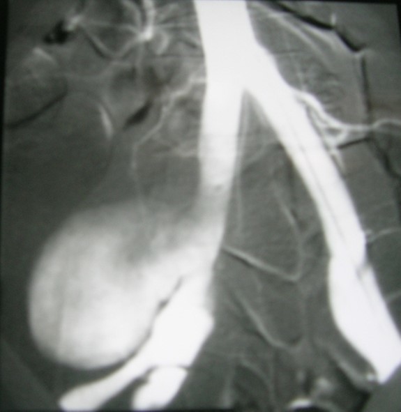  Artégraphie showed the saccular aneurysm. 