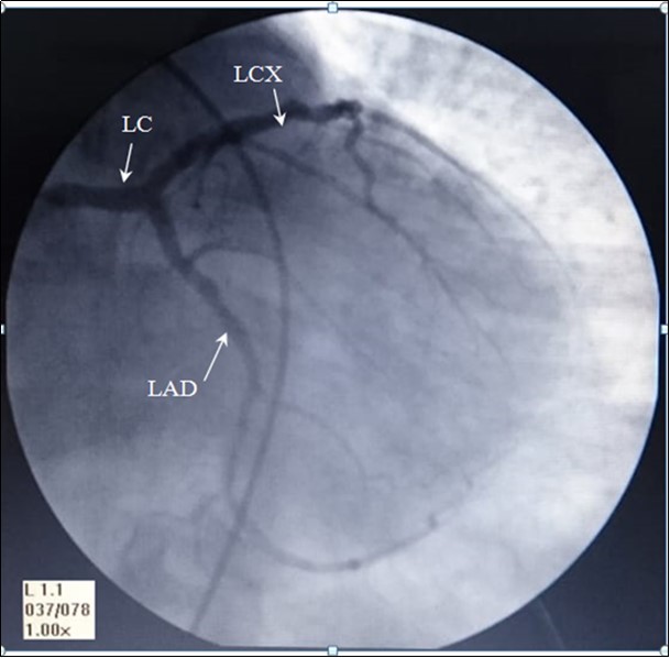  AP- anteroposterior angiographic view showing, Left coronary artery: LC, left anterior interventricular ( anterior            descending) artery: LAD, and Left Circumflex artery: LCX