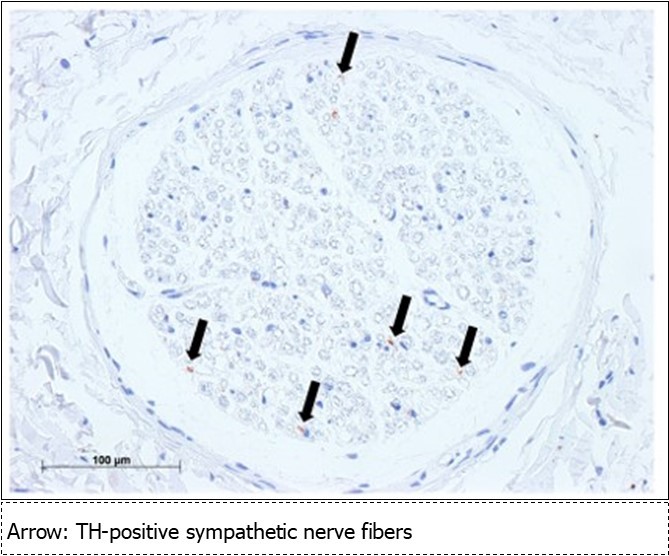  Sympathetic nerve fibers of the mandibular nerve (mental nerve: TH staining) Bar = 100um