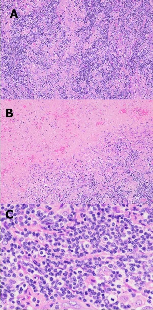  Representative photomicrographs of the excisional biopsy of a right neck lymph node. Low power view showing the lymph node architecture was effaced by a diffuse lymphohistiocytic infiltrate (A) with              extensive geographic necrosis (B). At high power, the lymphocytes are small to intermediate in size; they have round or oval to slightly irregular nuclei, coarse chromatin, and sometimes small nucleoli (C). (H&E stain; original magnification, x 100 A and B, x 400 C).