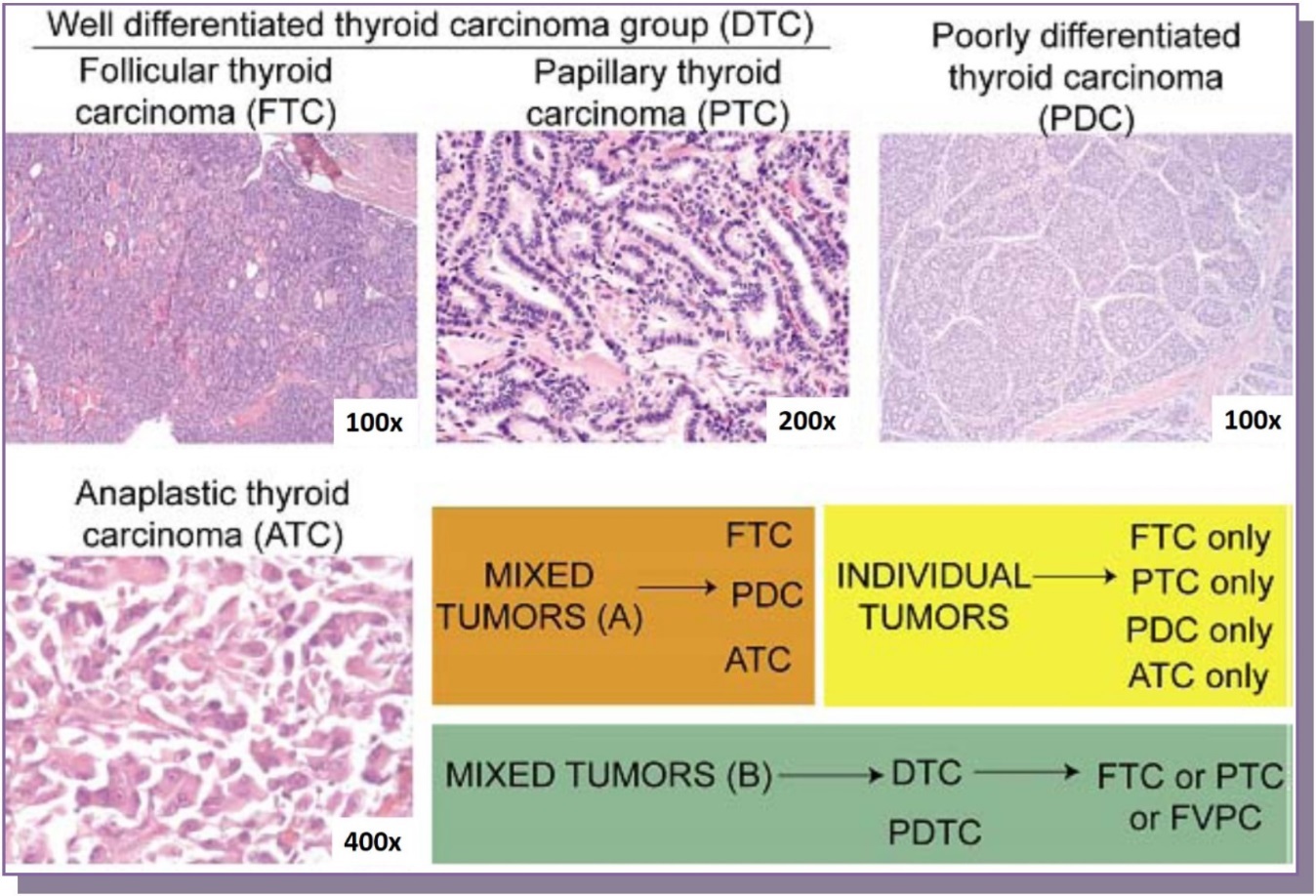   Representative histologies of well-differentiated thyroid carcinomas (follicular & papillary thyroid carcinomas, 100x and 200x magnification respectively), poorly differentiated thyroid carcinoma (100x) and anaplastic thyroid carcinoma (400x) are shown.  Cases were selected which either had a well-differentiated component, a mix of two tumors (well-differentiated and poorly differentiated, set B) or a mix of three (follicular carcinoma, poorly differentiated and anaplastic carcinoma, set A)