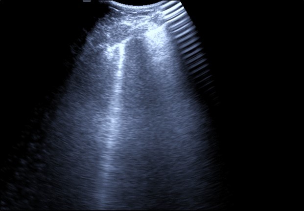 Real time chest ultrasound showing Kerley’s B lines in patient with covid -19.