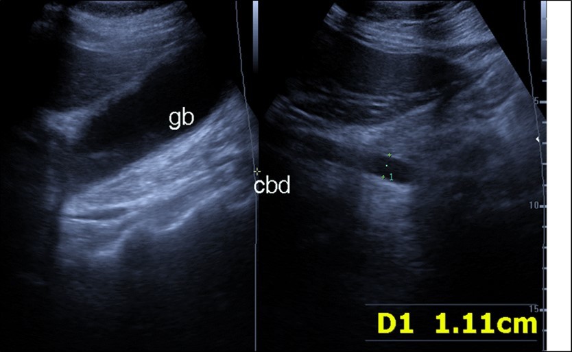  Real time ultrasound showing thickened wall of gall bladder (gb) with dilated Common bile duct (cbd) in patient with severe Covid-19.