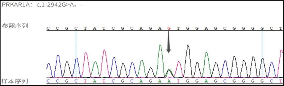  DNA sequence detection: variant gene PPKAR1A variant locus C.1-2942G>A, associated disease: Cushing's syndrome (primary pigmented nodular adrenocortical disease type 1, PPNAD1). 