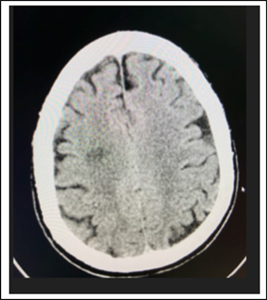  Cranial CT Scan plain, axial of the patient done 6 hours after onset of diplopia, shows a hypodense focus in the sub cortical  region of the right centrum semiovale extending to the right corona radiata