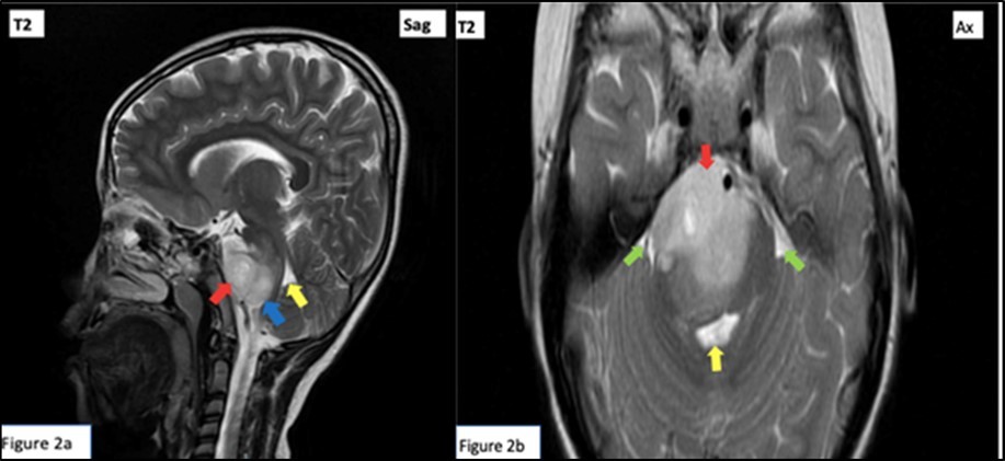  T2 Weighted cranial magnetic resonance imaging sagittal (a) and axial (b) cuts. 