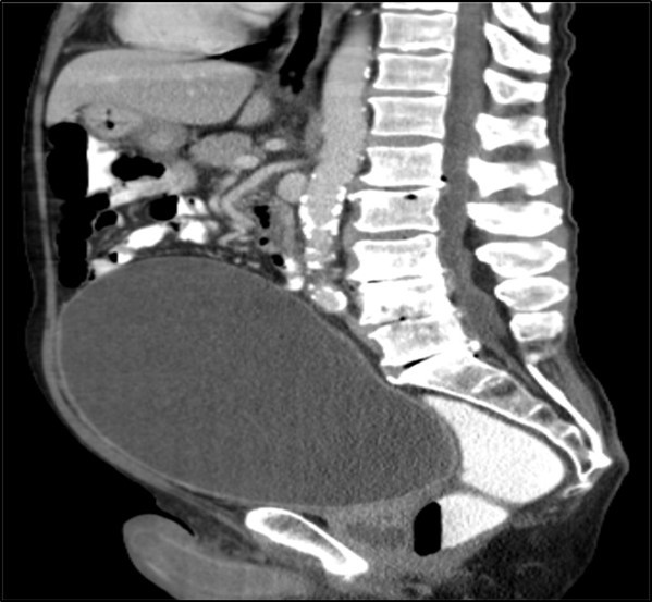  CT image showing a extremly dilated urinary bladder