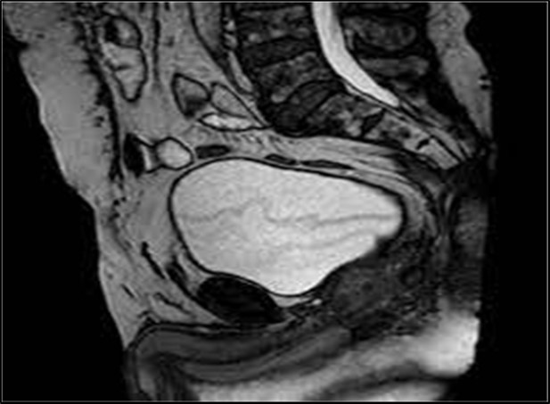  MRI of the same patient after catheterisation 