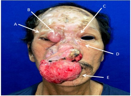  Preoperative picture showing extent of lesions. (A) 1.0x0.9x1.0cm firm, non-tender mass (B)3.0x3.0x1.8cm soft, erythematous, telangiectatic mass (C) 1.5x1.5cm soft, non-tender, nodular mass (D) 1.7x1.5cm firm, rubbery, nodular mass (E) 8.6x7.3x6.0cm firm, fungating nasal mass excised by Otorhinolaryngology service 