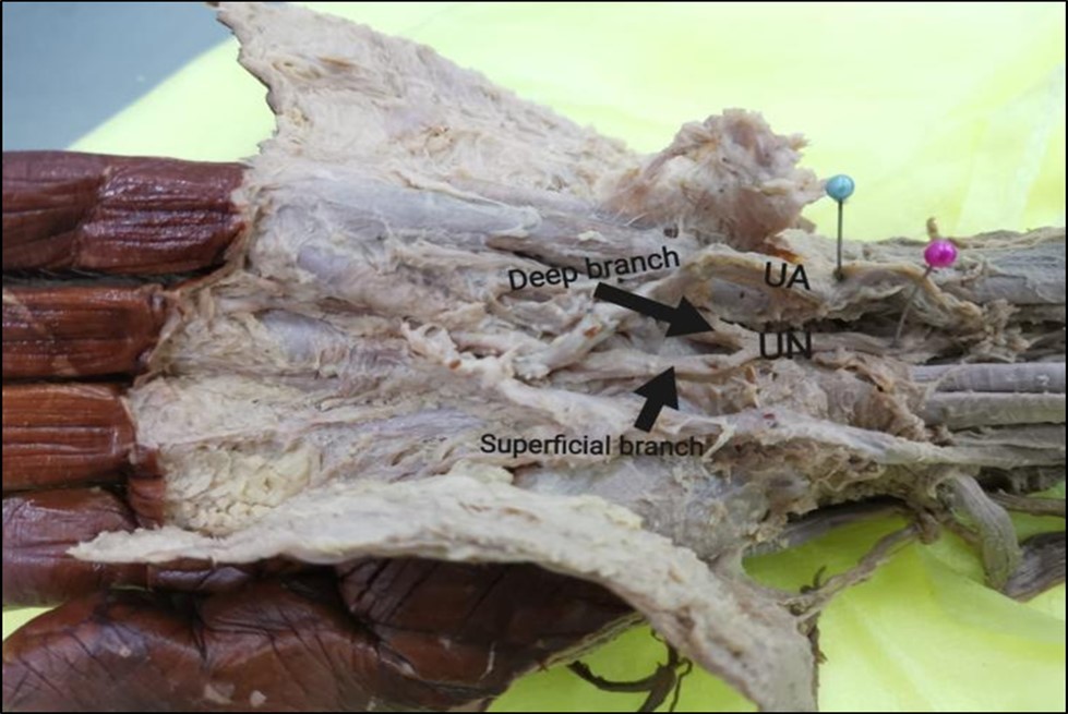  Photograph of the left-hand showing bifurcation pattern of the ulnar nerve. UA, ulnar artery; UN,ulnar nerve.