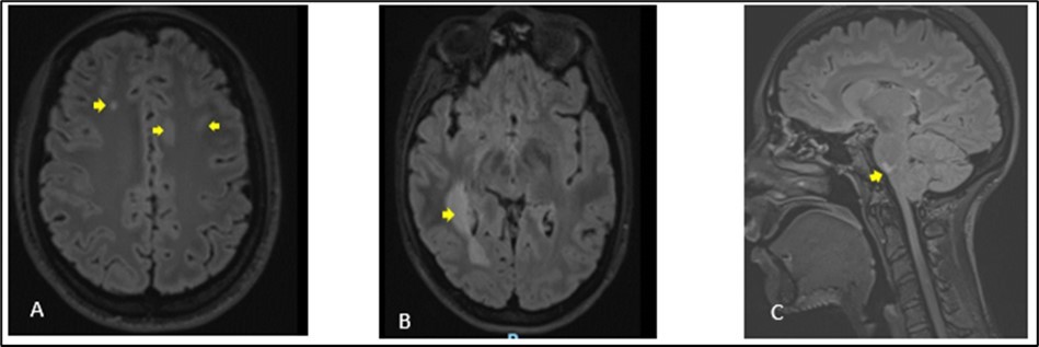  Cerebral MRI in FLAIR sequences showing multiple hyperintense lesions at the supratentorial (A, B) and infratentorial (C) levels. The largest supratentorial lesion (B) is opposite the right                            paraventricular white matter, at the level of the posterior horn and measures 55 x 17 mm axially.              Presence of a lesion of pons (C) of 6.5 mm.
