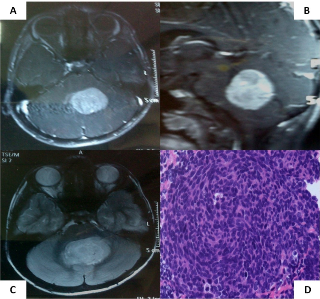  Pre-operative MRI of the brain showing a brilliantly enhancing midline vermian lesion in axial (A) and sagittal (B) T1-weighted post-contrast images with variable intensity on T2-weighted images (C). Photomicrograph of the tumor (D) showing it highly cellular tumor composed of small blue round cells consistent with classic medulloblastoma (X 400, hematoxylin & eosin)