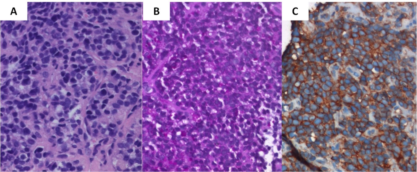  Biopsy from the tibial lesion (A) showed ‘undifferentiated small blue round cells’ on light microscopy (X400, hematoxylin & eosin). Vacuolated cells were positive for Periodic Acid Schiff stain (B), while small blue round cells showed diffuse membrane positivity for Mic-2 (C) 