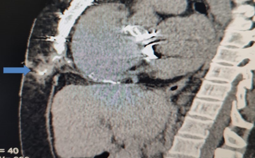  Sagittal CT-section of chest showing the extension of the sinus track             containing the contrast 