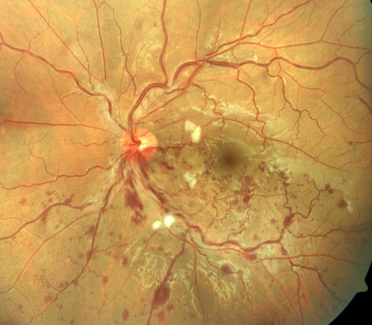  The figure shows evidence of BRVO in the left eye. There is dilatation and tortuosity of the affected venous segment, with flame-shaped and dot/blot haemorrhages, retinal edema and cotton wool spots in the section of the retina drained by the obstructed vein.