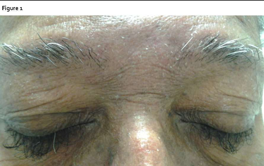  Note loss of eyebrow hair with paradoxical trichomegaly and trichiasis of the eyelashes.