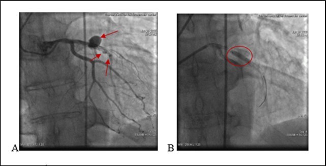  A. (21.06.2020) Second acute stent thrombosis and perforation Type III and II (red arrows) B. Balloon inflation in the site of rupture (red circle).
