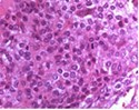  Chondroblastoma demonstrating round to oval chondroblastic cells with abundant, eosinophilic cytoplasm and vesicular grooved nuclei encompassed within a myxochondroid matrix5.
