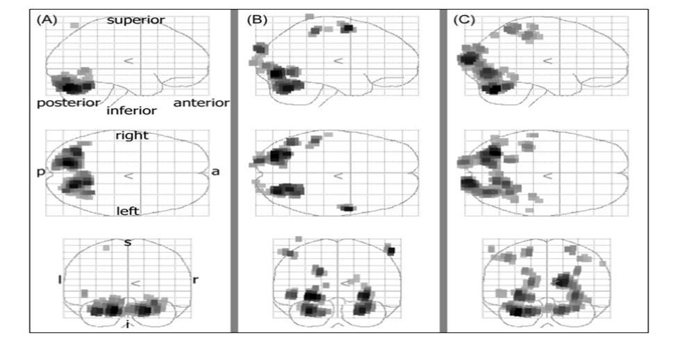  Result of stimulation 1. The black areas denote active brain regions (P<0.05). (A) Condition 1. Activations was detected in bilaterally primary visual cortex. (B) Condition 2. Activations was detected in bilaterally primary visual cortex and dorsal visual pathway. (C) Condition 3. Activations was detected in bilaterally primary visual cortex and dorsal visual pathway.