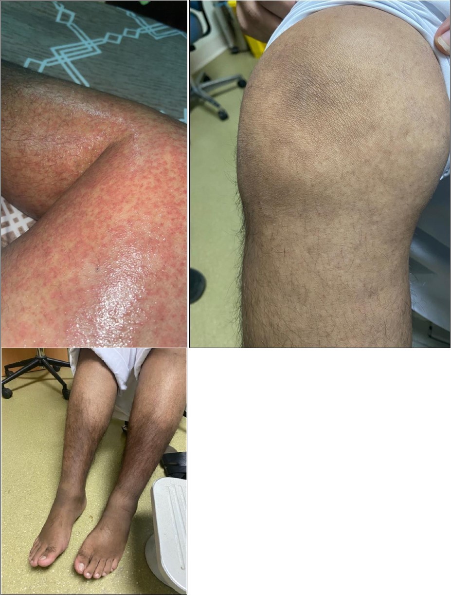 Maculopapular rash, biopsy showed evidence of vasculitis (A). After 3 months of initiation of         anti-TNF (adalimumab), showed resolution of the maculopapular rash (B). Hyperpigmentation in legs (C)
