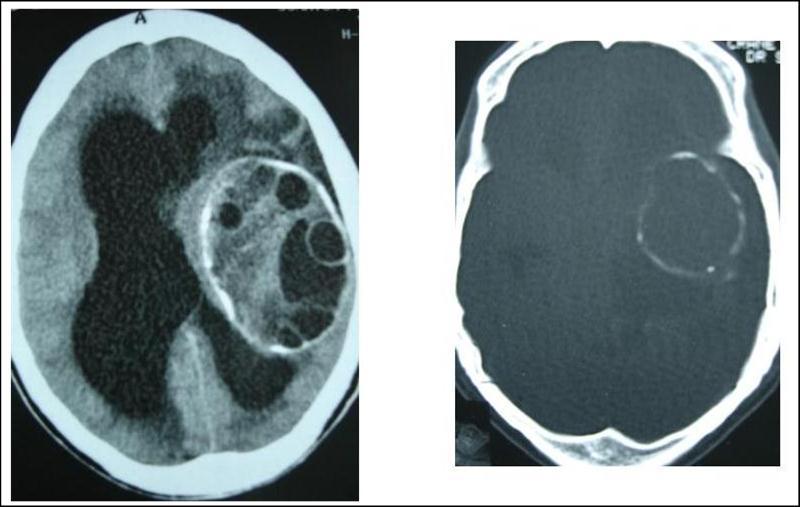  axial CT scans of brain showing multiple hydatid cysts (A) with calcified capsule (B).