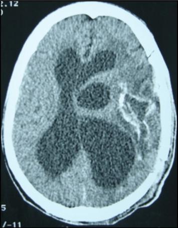  post operative CT scan showing the residual capsule. 