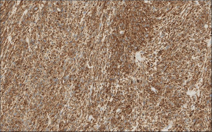 Left thyroid Cells are diffusely positive for Caldesmon immunohistochemistry (IHC, x200)