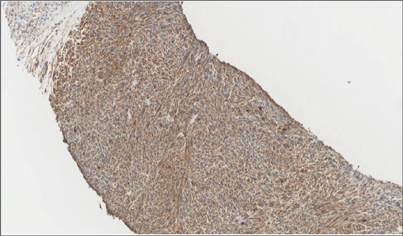  Liver Biopsy IHC of the metastatic foci shows diffuse positivity for Caldesmonstain (IHC,×200).