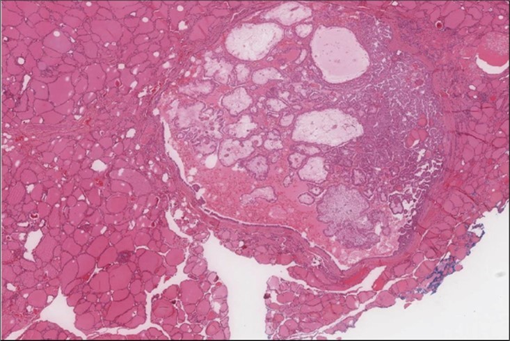  Right thyroid Right thyroid lobe shows foci of papillary thyroid carcinoma. (H&E, x4)).