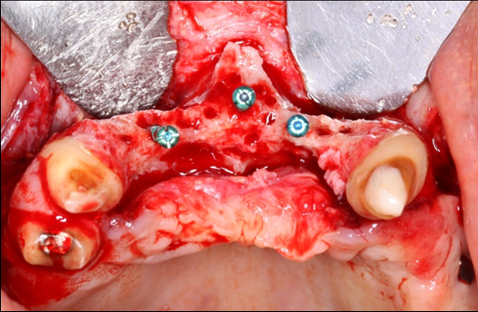  Occlusal view of the pre-maxilla after elevation of amucoperiosteal flap. Noteright and left pre-maxilla buccal plate concavities due to severely resorbed ridge. The central tenting screw is located mid-way into the nasal spine.