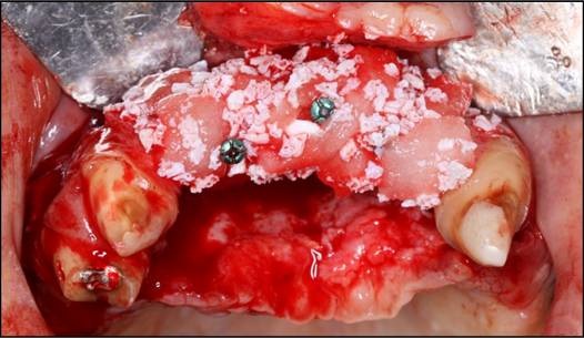  Occlusal view of the pre-maxilla after placement of strips of the rhBMP-2/ACS added to the natural bone mineral component derived from bovine bone.