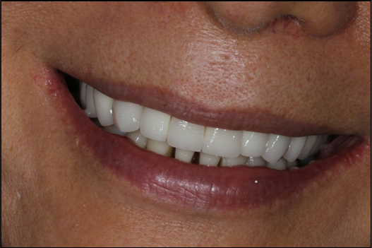  One-year follow-up after delivery of 4 porcelain-fused-to-metal crowns. 