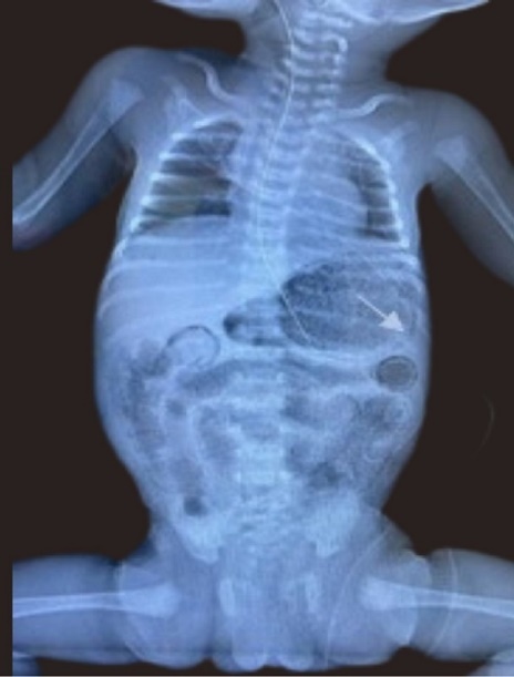  Anterior posterior Chest and abdominal radiograph showing gastric pneumatosis (arrow shown) and pneumatosis intestinalis.